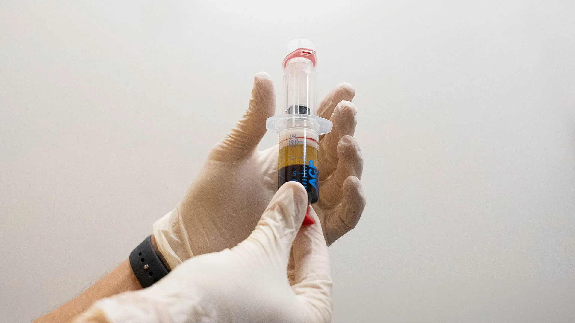 Platelet-rich plasma (PRP) preparation for injection used in regenerative medicine for joints, tendons, and ligaments (illustrative).
